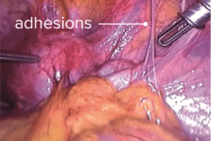 Endometriosis adhesions